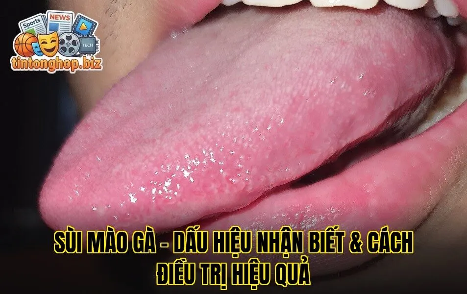 Sùi Mào Gà – Dấu Hiệu Nhận Biết & Cách Điều Trị Hiệu Quả