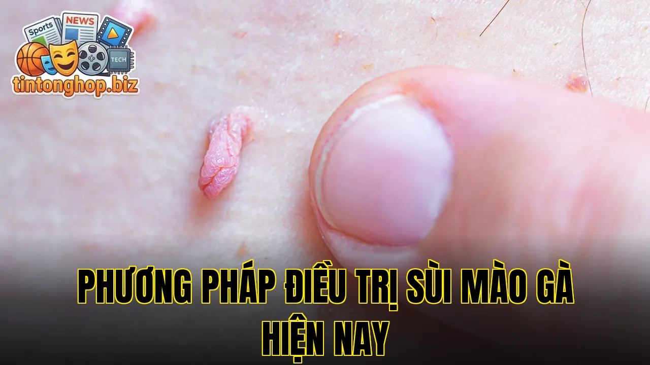 Phương pháp điều trị sùi mào gà hiện nay