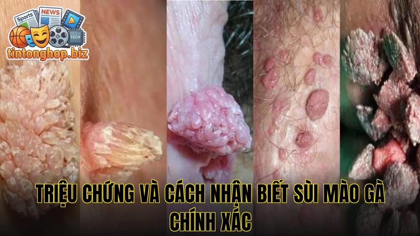 Triệu chứng và cách nhận biết sùi mào gà chính xác